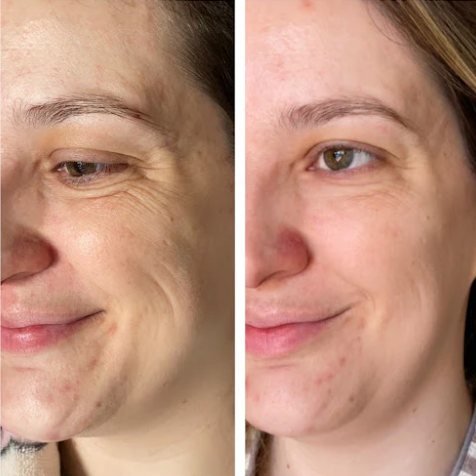 Collagen Boost™ | Reduce Líneas y Arrugas - 24 KITS de Parches de Colágeno Intensivos