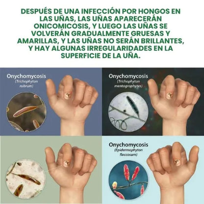 7 DAYS FUNGUS FREE NAILS® | PROTEGE Y ELIMINA EL HONGO DE TUS UÑAS